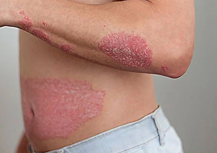 Psoriasis Treatment