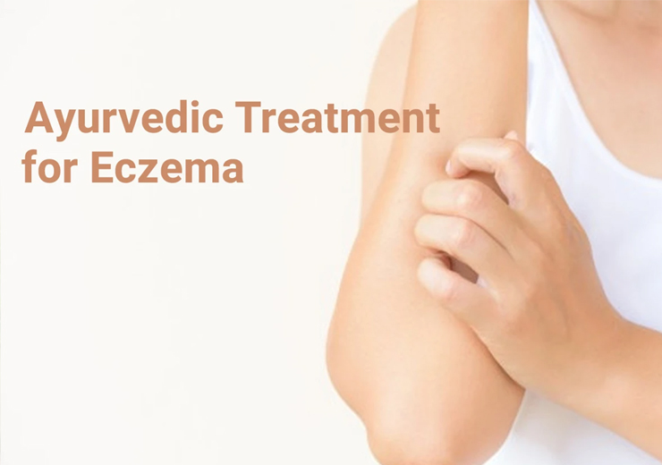 Ayurveda Eczema Treatment